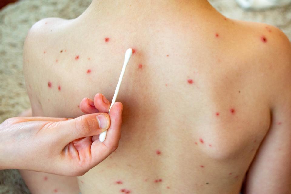 Natural vaccination. Contagious disease. Sick child with chickenpox. Varicella virus or Chickenpox bubble rash on child body and face. High quality photo