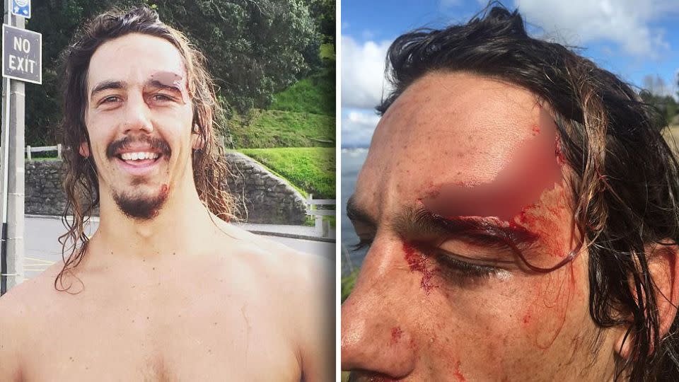 Travis McCoy was left with a deep gash above his eye after being cut open by the fin on his surfboard. Source: Instagram