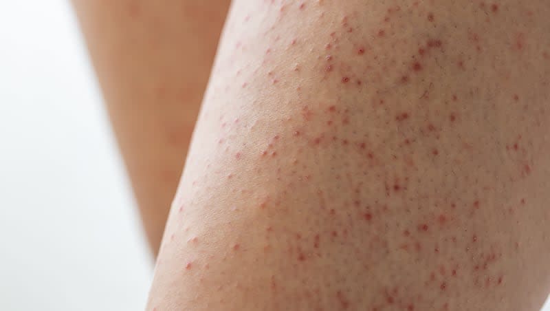Keratosis pilaris is also called chicken skin because of its distinctive appearance: skin bumps that look like plucked chicken skin.