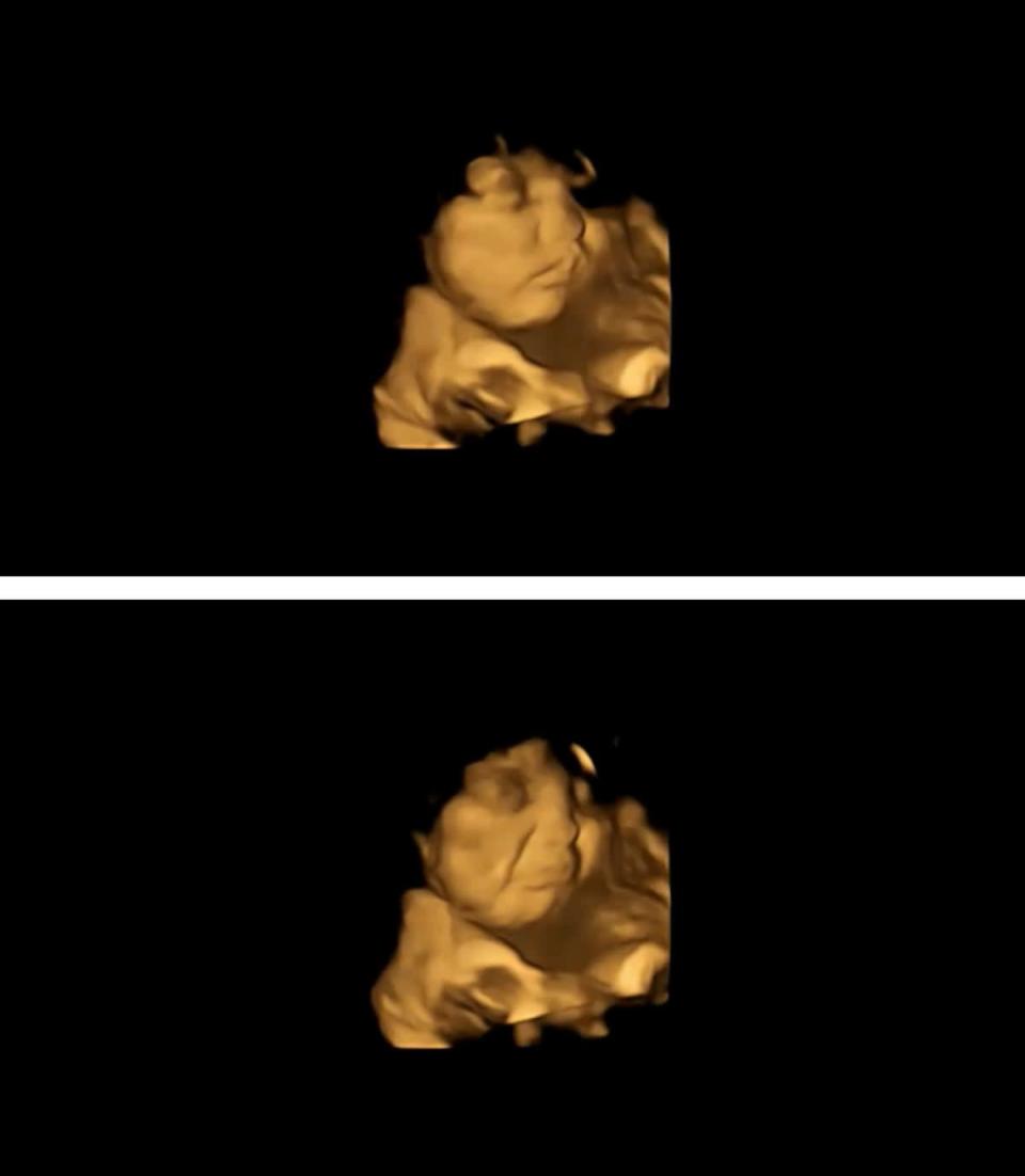 Imagen del folleto de un escaneo 4D de un feto que muestra una cara neutra (arriba) y el mismo feto que muestra una reacción de cara de llanto después de haber estado expuesto al sabor de la col rizada (Universidad de Durham/PA) (PA Media)