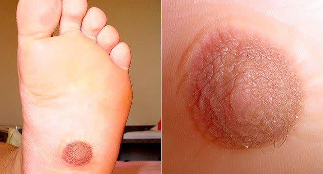 Third nipple discovered on a 22yo woman's foot. Photo: Dermatology Online