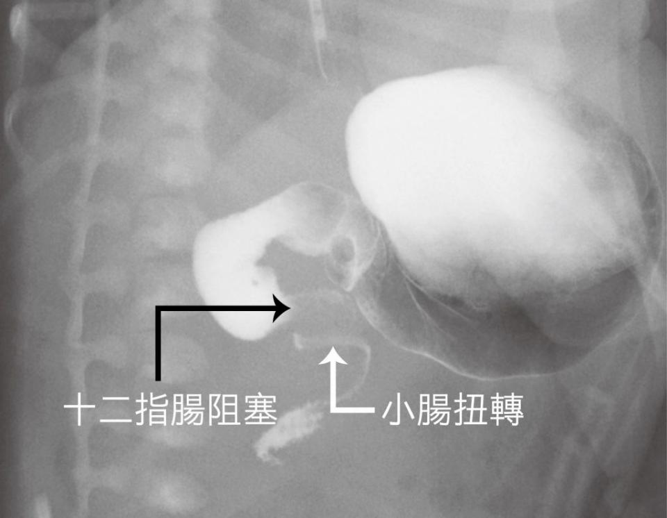 2名出生未滿3天的男嬰，媽媽親自哺乳，卻吐奶吐到出現膽汁，原來先天性腸旋轉不良症，經過緊急手術，恢復腸道暢通。（記者陳金龍攝）