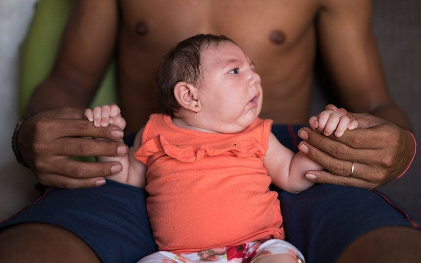 A baby suffering from microcephaly in Brazil -  Felipe Dana