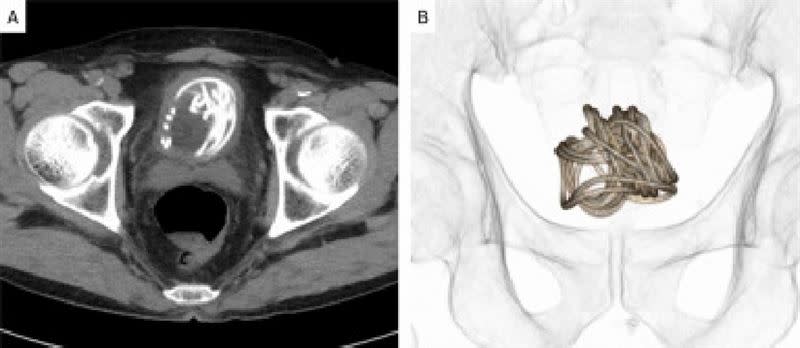 跳繩在老翁體內糾纏一團。（圖／翻攝自Urology Case Reports）