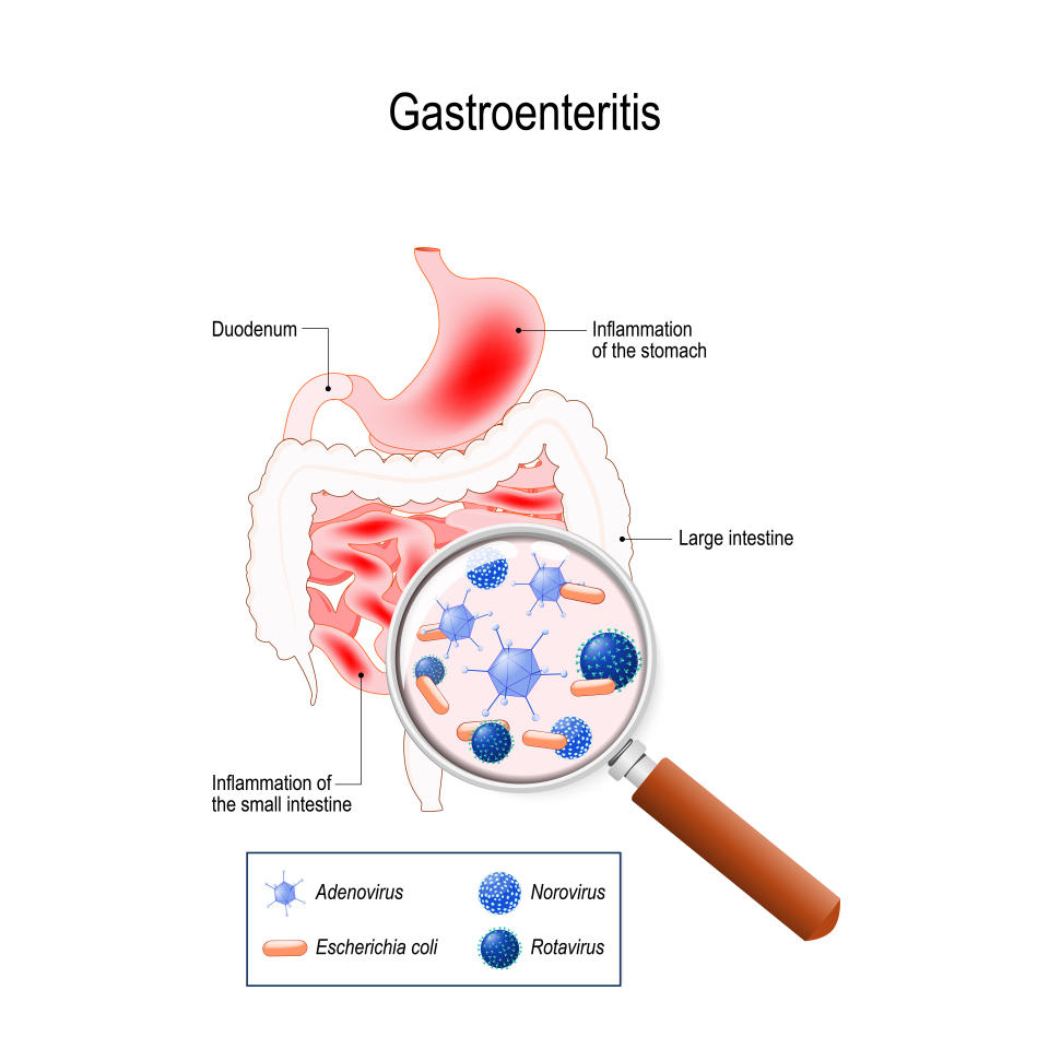 La gastroenteritis es una diarrea infecciosa, inflamación del tracto gastrointestinal (estómago e intestino delgado). causada por virus (rotavirus, adenovirus, norovirus) y bacterias Escherichia coli. (Imagen: Getty)