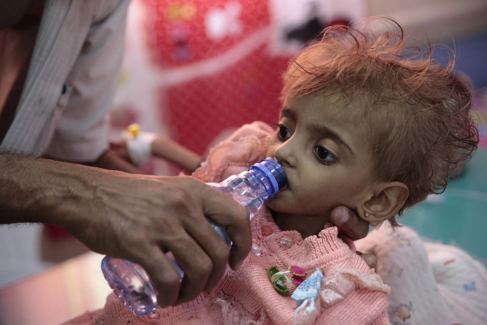 FILE - In this Thursday, Sept. 27, 2018, file photo, a father gives water to his malnourished daughter at a feeding center in a hospital in Hodeida, Yemen. An international aid group says an estimated 85,000 children under age 5 may have died of hunger and disease since the outbreak of Yemen's civil war in 2015. (AP Photo/Hani Mohammed, File)