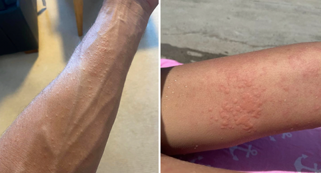 Aussies stumped by mysterious rash after swimming at popular beaches