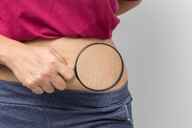 Can Vicks Vaporub Really Get Rid Of Stretch Marks?