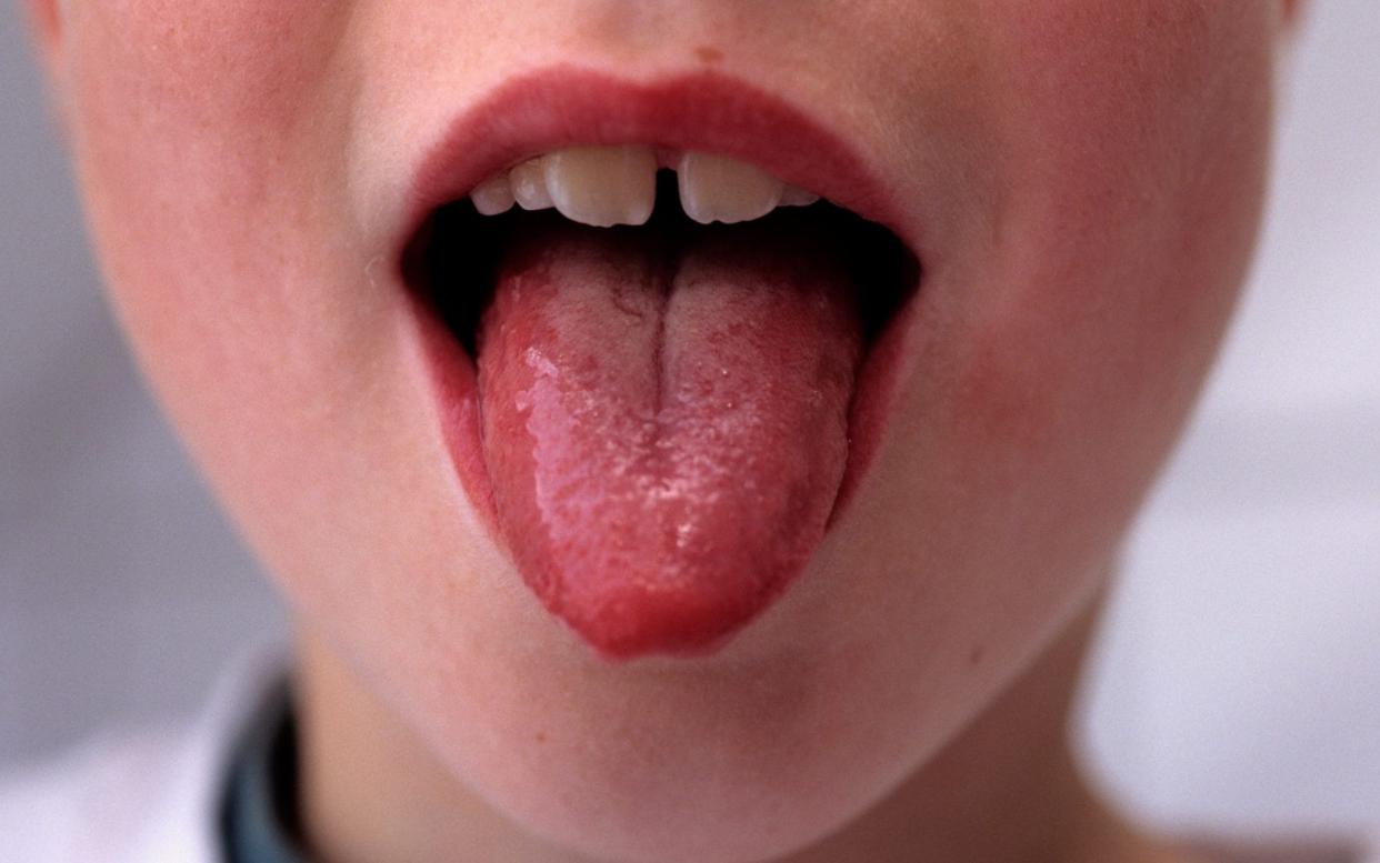 strep a tongue - imageBROKER / Alamy