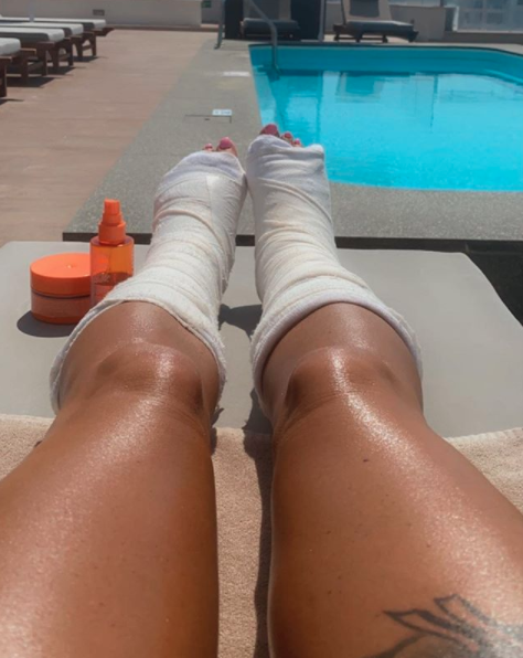 Katie Price with. broken feet in Turkey