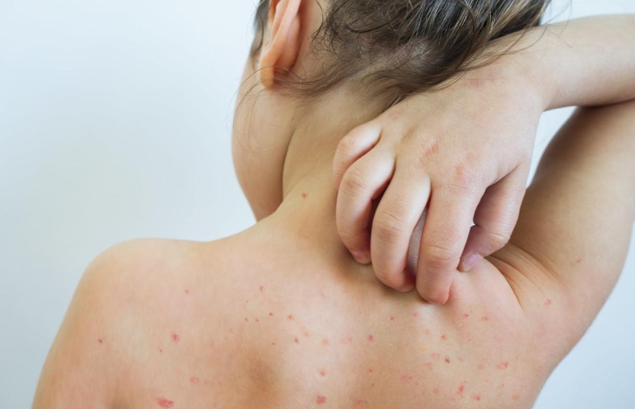 Most children today receive the chickenpox vaccine as a routine part of childhood immunizations. <a href="https://www.gettyimages.com/detail/photo/chickenpox-royalty-free-image/1144939011?adppopup=true" rel="nofollow noopener" target="_blank" data-ylk="slk:Solidcolours/E+ via Getty Images;elm:context_link;itc:0;sec:content-canvas" class="link ">Solidcolours/E+ via Getty Images</a>