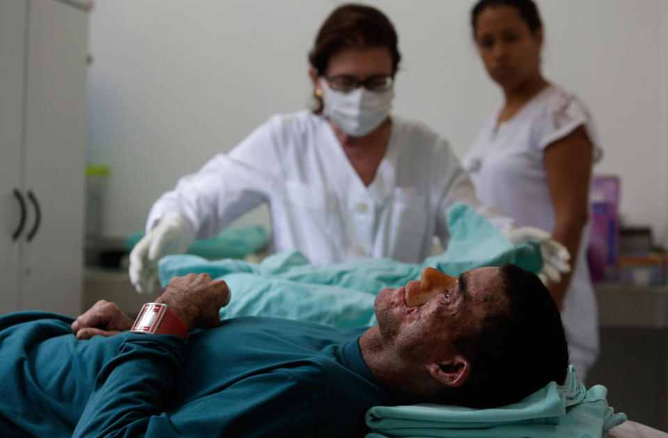 In this April 9, 2014 photo, Dr. Sulamita Chaibub assists Djalma Antonio Jardim, who has a rare inherited skin disease known as xeroderma pigmentosum, or "XP," at the Hospital Geral de Goias in Goiania, Goias state, Brazil. Both of Jardim's parents were carriers of the gene that causes the disease, largely ensuring that he would have it. (AP Photo/Eraldo Peres)