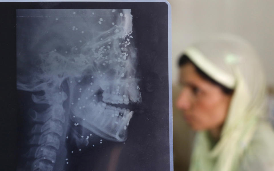 Pellet injuries on X-ray