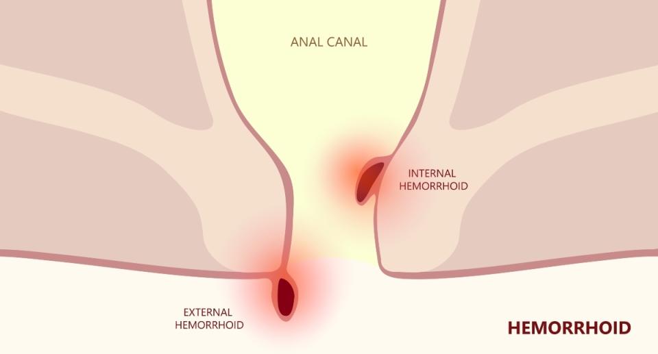 Internal and external hemorrhoids