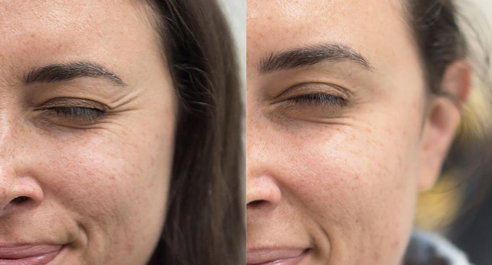 Before and after pictures of lines around the eyes 