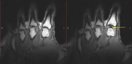 A pair of undated handout images courtesy of the University of Alberta in Edmonton, Canada show what happens inside finger joints to cause the distinctive popping sounds heard when cracking knuckles. REUTERS/University of Alberta/Handout via Reuters