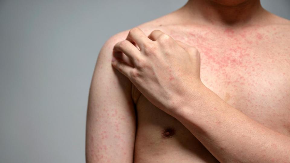 PHOTO: Stock photo of a person with a measles-like rash. (STOCK PHOTO/Getty Images)