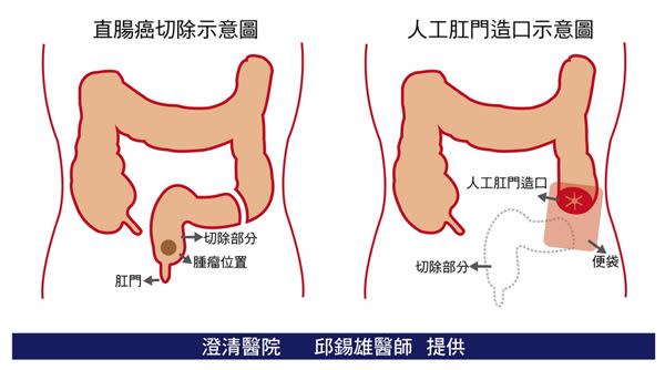 癌細胞餓不死！女節食腸癌變末期