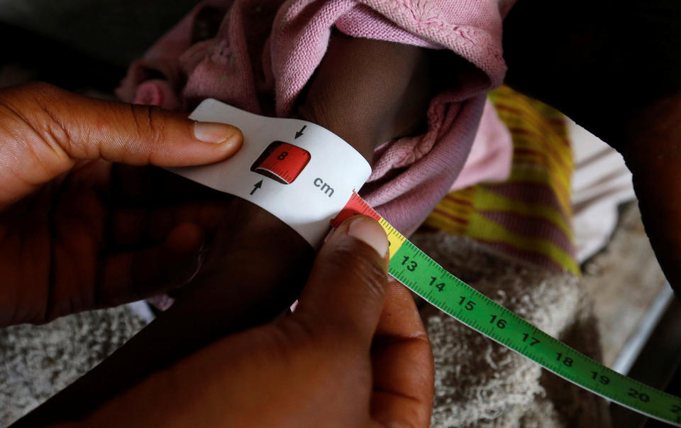 <p>A severely acute malnourished and internally displaced Congolese child is screened at the Tshiamala general referral hospital of Mwene Ditu in Kasai Oriental Province in the Democratic Republic of Congo, March 15, 2018. (Photo: Thomas Mukoya/Reuters) </p>