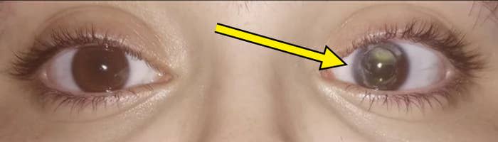 Close-up of a person's eyes. The right eye appears normal while the left eye has an abnormality, with a dark spot covering the iris and pupil area