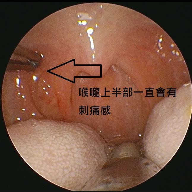 一名婦人自述右邊喉嚨痛已經有超過半年的時間，沒想到，竟是喉嚨長骨刺，必須要開刀把骨刺取出來！（圖／陳亮宇醫師授權使用）