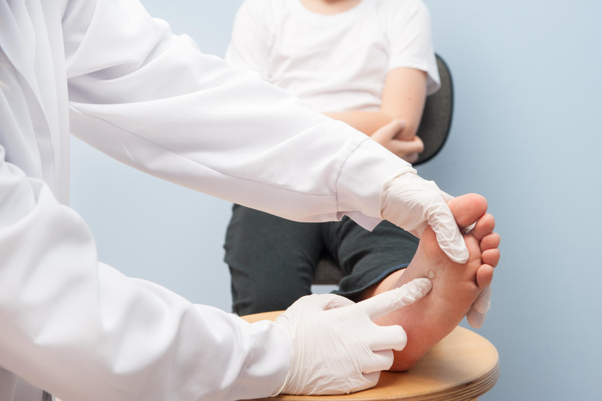 A doctor, wearing gloves, points out a wart on the bottom of a child’s foot.