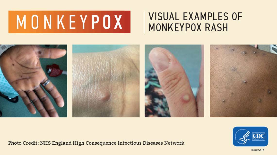 Here’s what to know about monkeypox in Illinois.