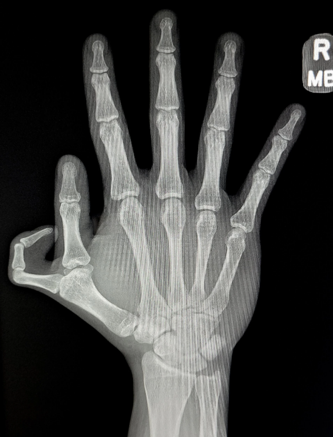 An X-ray image of a human hand with skeletal structures and joints clearly visible, showing the thumb, index, middle, ring, and pinky fingers