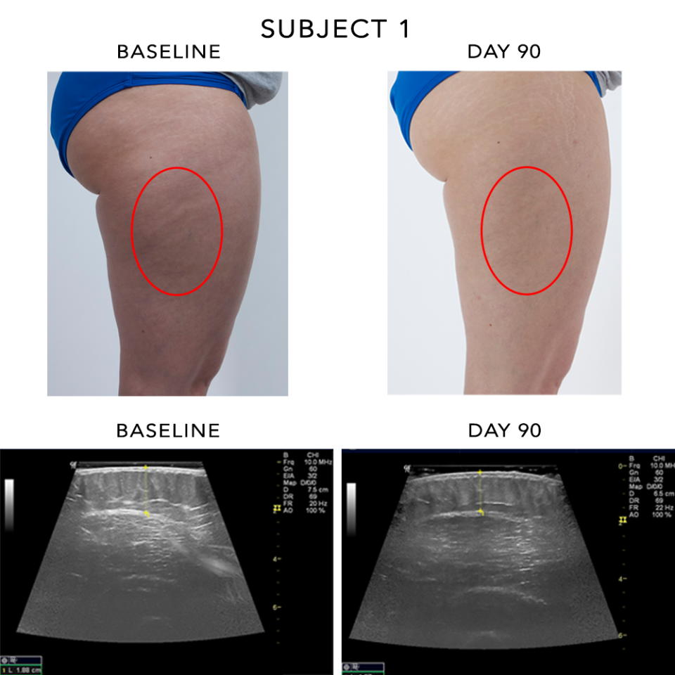 The results of a 90-day study carried out by Ashley Black in which participants were told not to change their diet or lifestyle, but to start using the FasciaBlaster