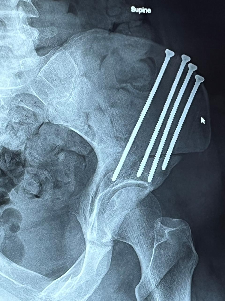 Reporter Jennifer Pignolet's X-ray following a PAO surgery to correct hip dysplasia. A portion of the pelvis around the joint is cut, rotated and screwed into place.