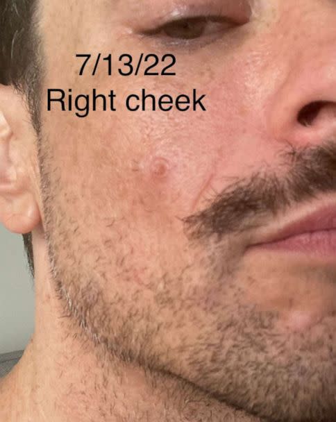 PHOTO: A lesion on Jeffrey Todd's right cheek the day he was tested for monkeypox, July 13, 2022. (Courtesy Jeffrey Todd)