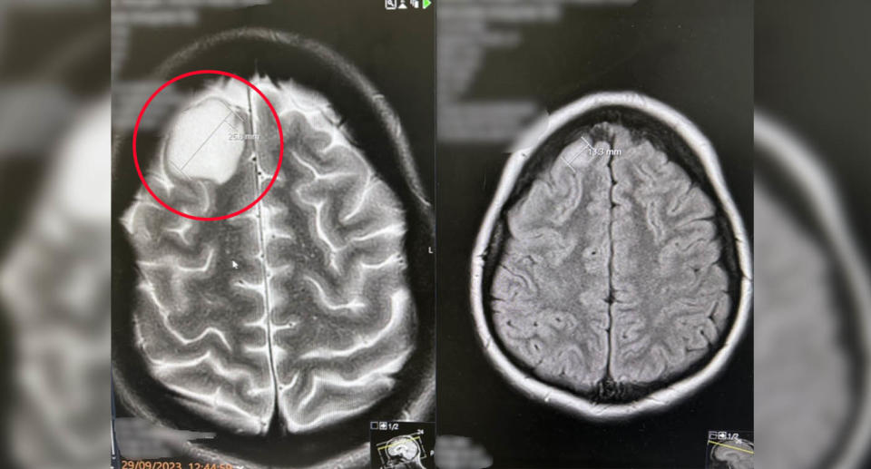 X-ray showing large tumour on brain. 