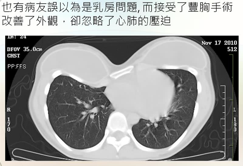 30多歲女患者，去做隆乳手術反而增加對心肺功能的壓迫（圖／三軍總醫院提供）