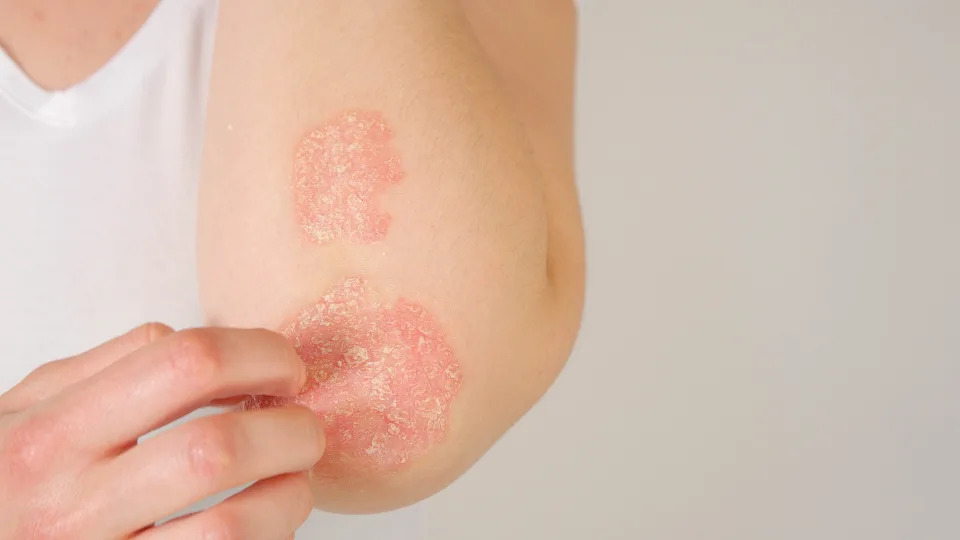 乾癬又名銀屑病，常見症狀為患部出現紅色斑塊、脫屑。 （示意圖／Getty Images）