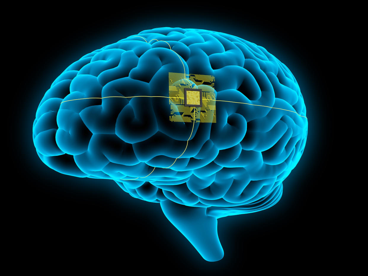 x-rays of the human brain with an implanted chip. 3D render.