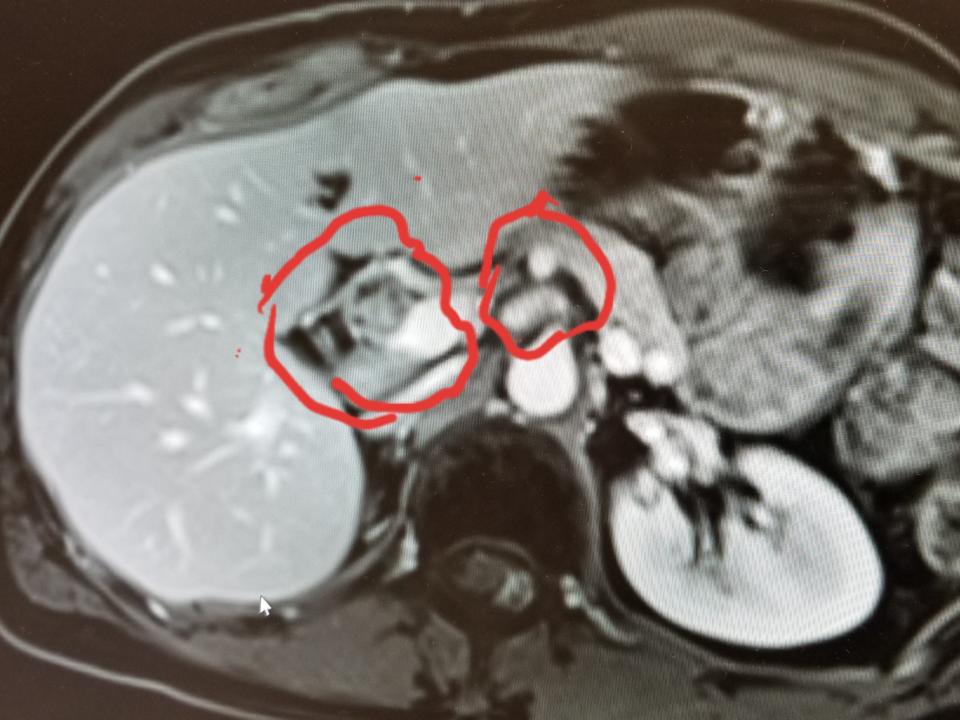 An MRI scan showing two tumors near a patient's liver