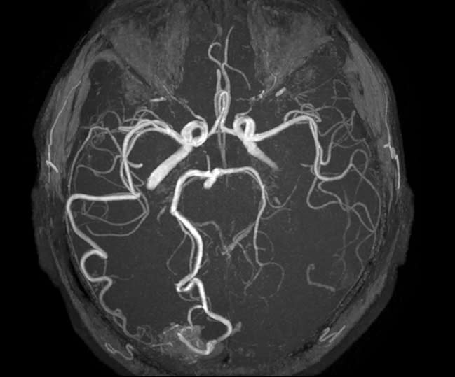 x ray of a vein showing veins