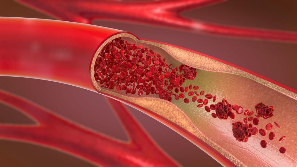 8 Signs of a Blood Clot You Should Never Ignore, According to Doctors