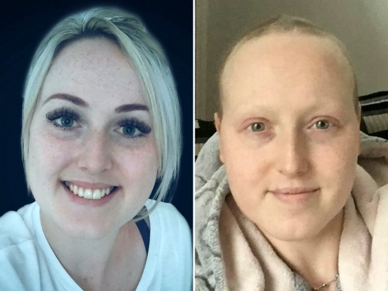 Sarah Boyle before she was wrongly diagnosed with breast cancer (left) and after treatment (right). (Sarah Boyle/SWNS)