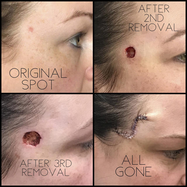 Skin Cancer Removal Before-After - DrDavid Mueller - Virginia Facial  Surgery