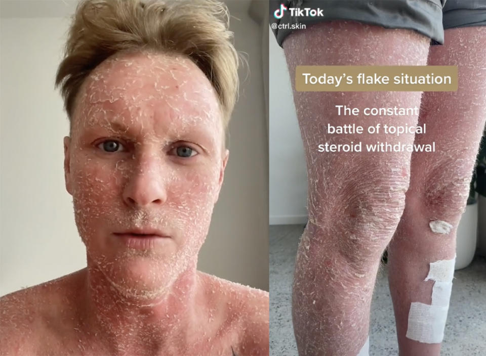 Jordan Hendey documents peeling skin on his face and legs.