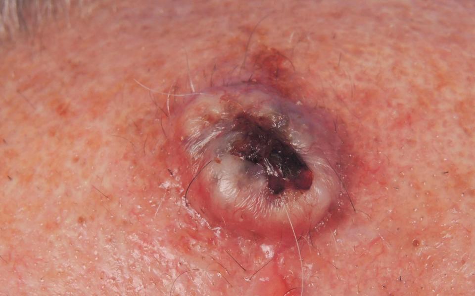 Squamous cell carcinoma has the ability to spread to the lymph nodes and other organs