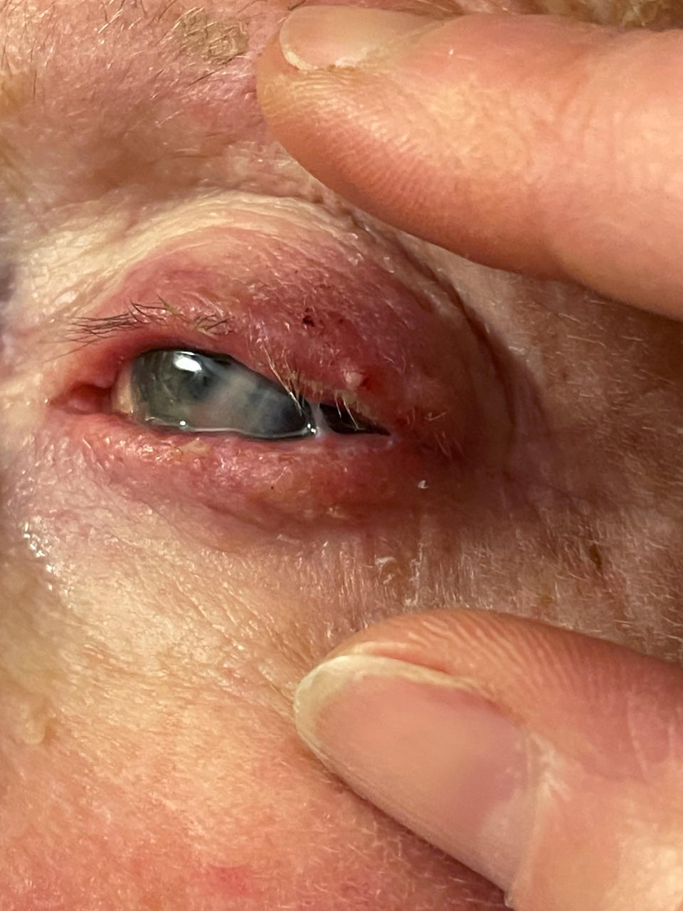 This photo of Judy Gregory's eye was taken in January, eight months after she was initially infected. (Courtesy Kim Harrison)