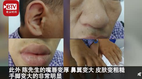 陳男嘴唇變厚、鼻翼變大、手腳變大。（圖／翻攝自北京時間）