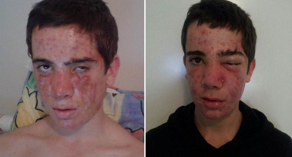 Jordan pictured as a teen with boils and blisters on his face.