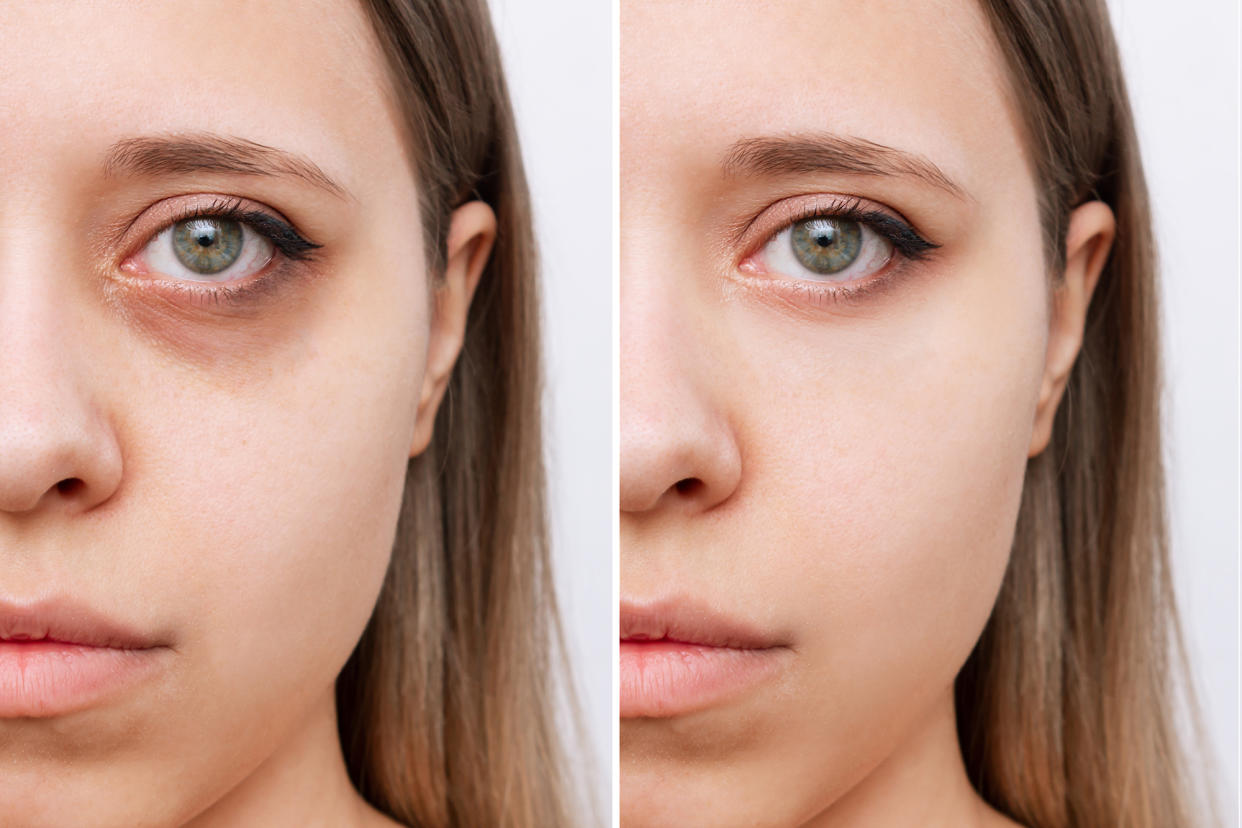 Cropped shot of young woman's face with dark circles under eyes before and after cosmetic treatment.