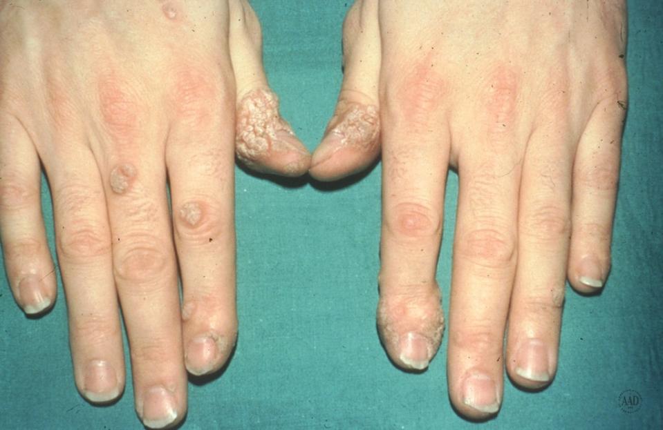 <cite class="credit">Courtesy of the American Academy of Dermatology</cite>