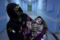 A woman holds her malnourished baby at the Ataturk Children's Hospital in Kabul, Afghanistan, Wednesday, May 18, 2022. Some 1.1 million Afghan children under the age of five will face malnutrition by the end of the year. , as hospitals wards are already packed with sick children . (AP Photo/Ebrahim Noroozi)