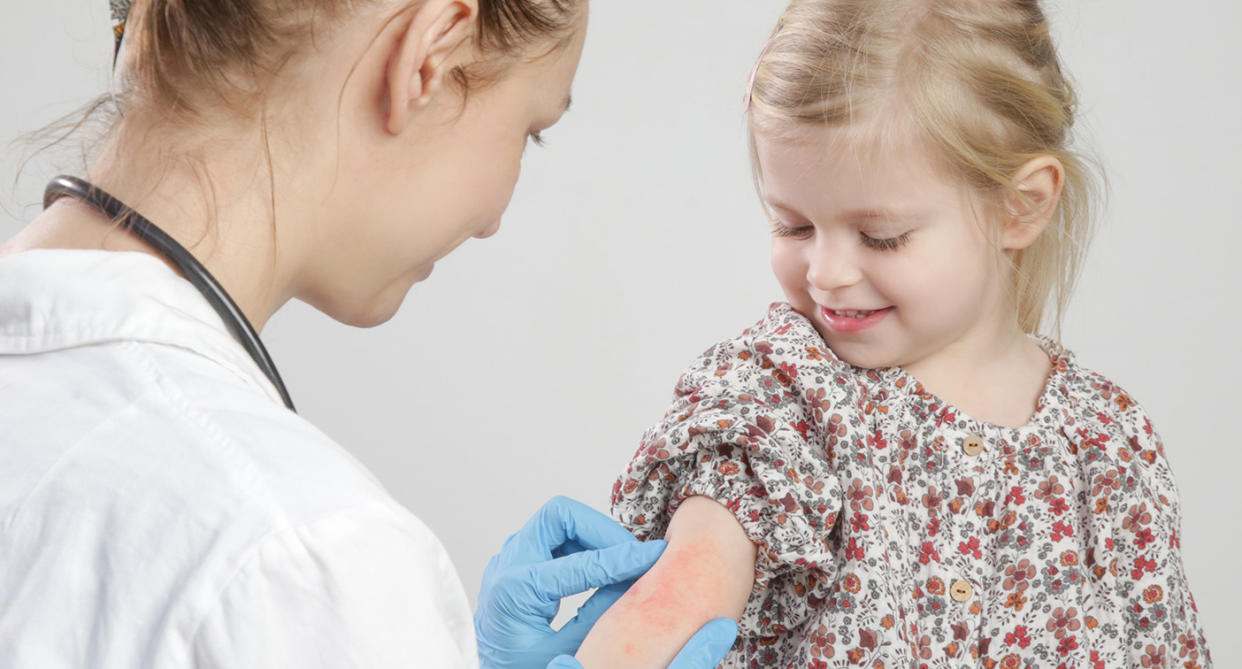 Allergy in child at doctor. (Getty Images)