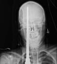 An X-ray showing a spear that has pierced through the head of 16-year-old Yasser Lopez is seen in this handout photo from Jackson Memorial Hospital in Miami, Florida provided to Reuters June 19, 2012. Lopez was spear fishing with a friend when he was accidentally shot in the head. The spear entered just above his right eye, and penetrated through his brain to the back of his skull. Miraculously, no vital brain structures were damaged by the harpoon, and Lopez is now recovering from the incident. REUTERS/Jackson Memorial Hospital/Handout